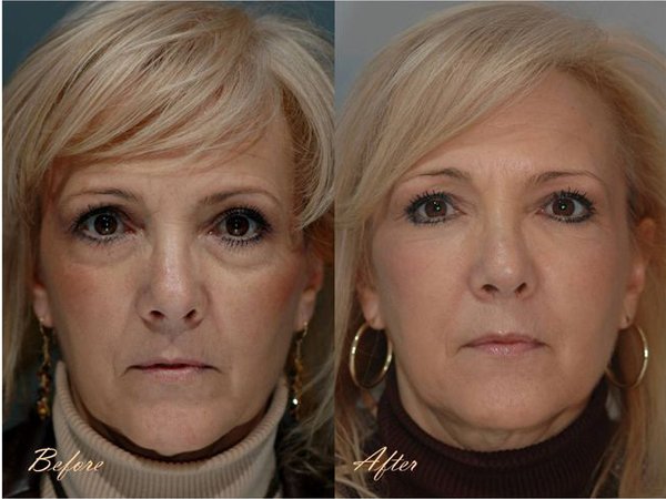 Blepharoplasty