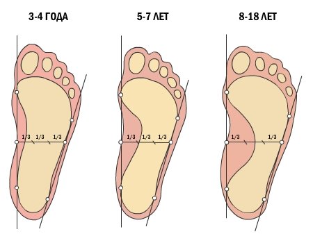 Детское плоскостопие